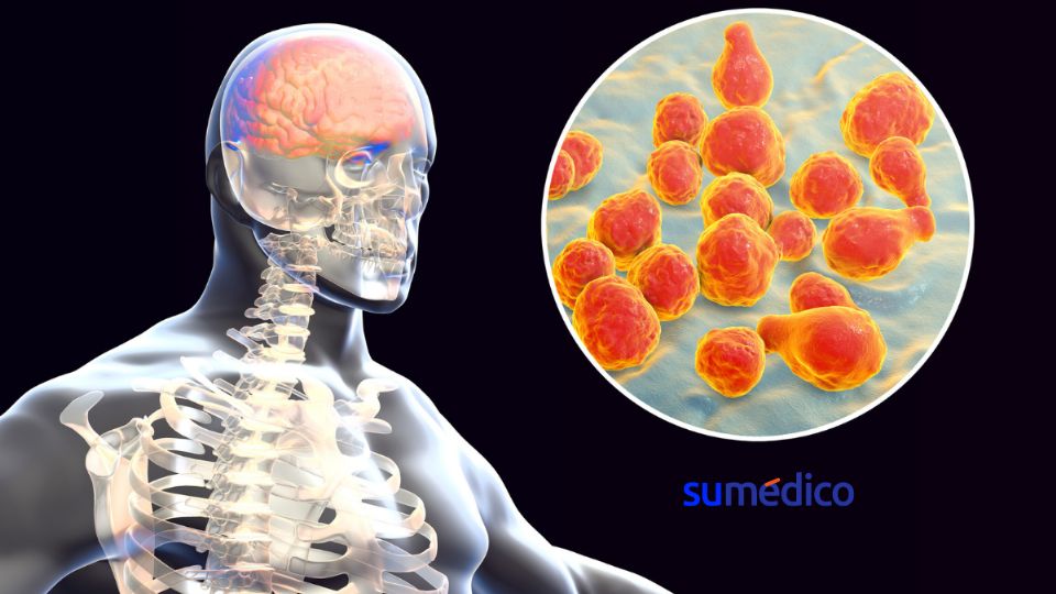 La meningitis fúngica puede ser letal para el organismo.