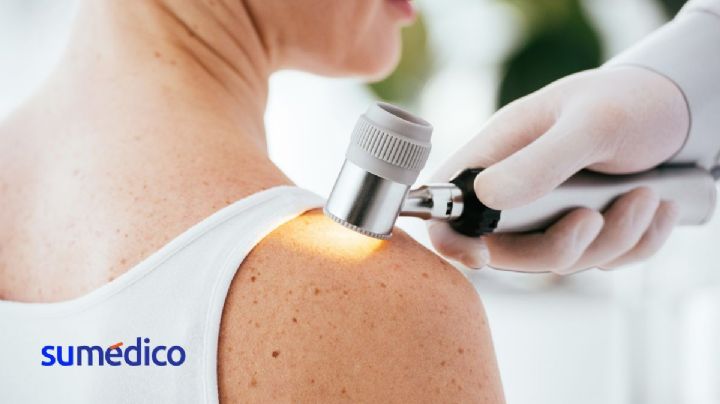 El cáncer de piel que puede volverse uno de los más frecuentes en el mundo