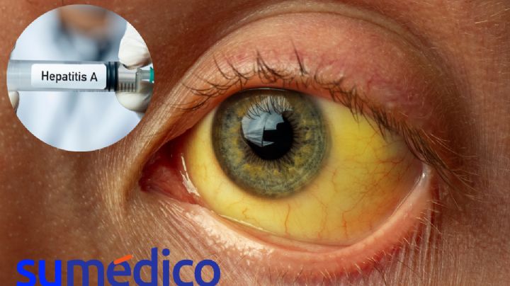 ¿Cómo saber si estás enfermo de Hepatitis A?