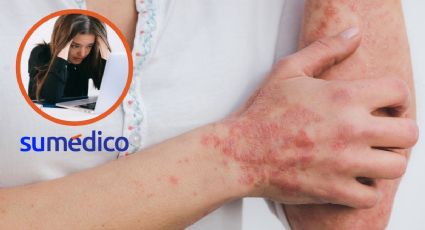 “La psoriasis tiene una carga emocional; sentía incomodidad de que me vieran"