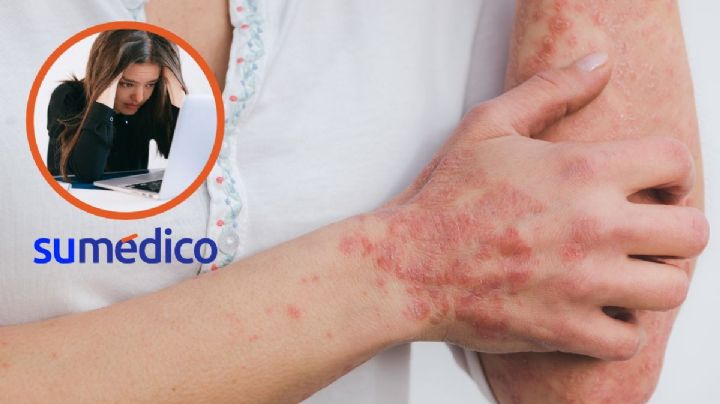 “La psoriasis tiene una carga emocional; sentía incomodidad de que me vieran"