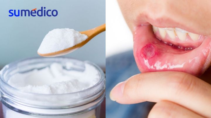¿El bicarbonato de sodio cura heridas en la boca?