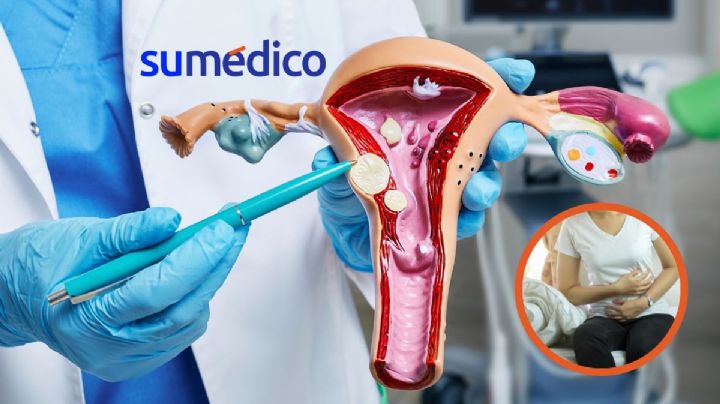Tras un dolor abdominal intenso, le retiran tumor de más de 10 kilogramos en el IMSS-Bienestar
