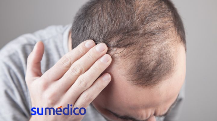 ¿Cuál es el medicamento contra la alopecia que aprobó la FDA?