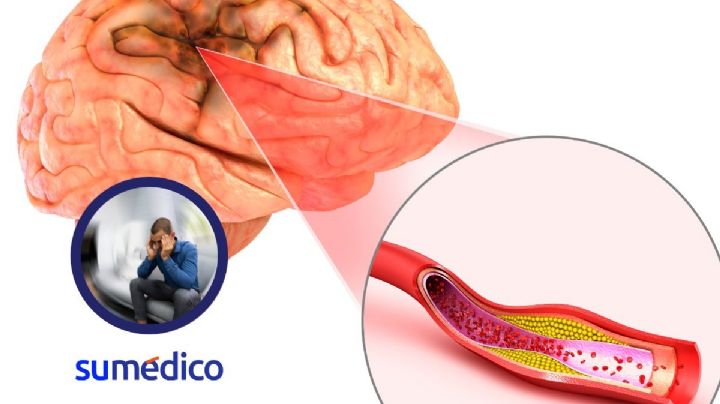 5 síntomas faciales que te avisan de un accidente cerebrovascular