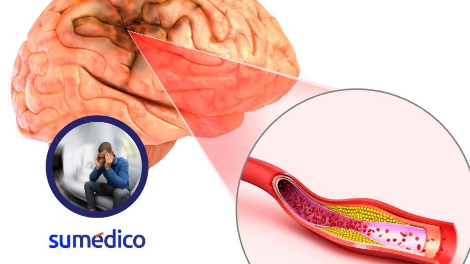 ¿Cómo prevenir los efectos del ictus? Identifica estos síntomas antes de que sea tarde.