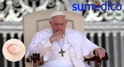 El Papa Francisco será operado de una hernia incisional, ¿qué es?