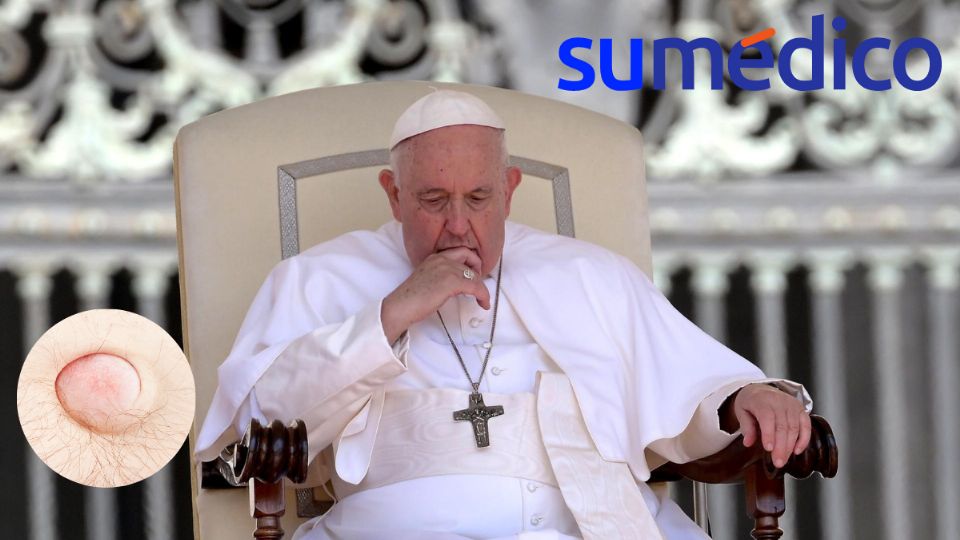 El papa Francisco será operado.