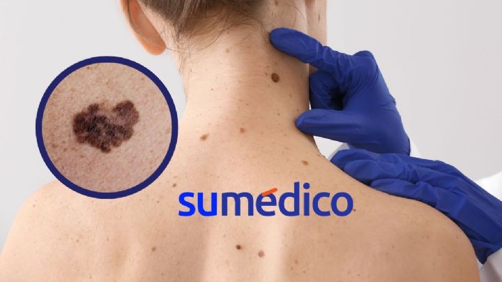 ¿Tienes uno o varios lunares? Toma en cuenta estas recomendaciones para prevenir cáncer de piel