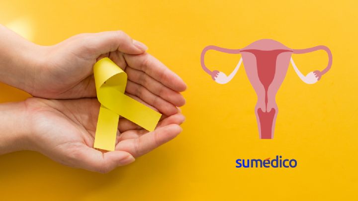 Sarcoma en el útero puede confundirse con miomas: especialista