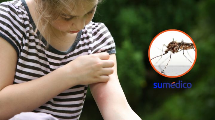 Truco para aliviar las picaduras de mosquito este verano