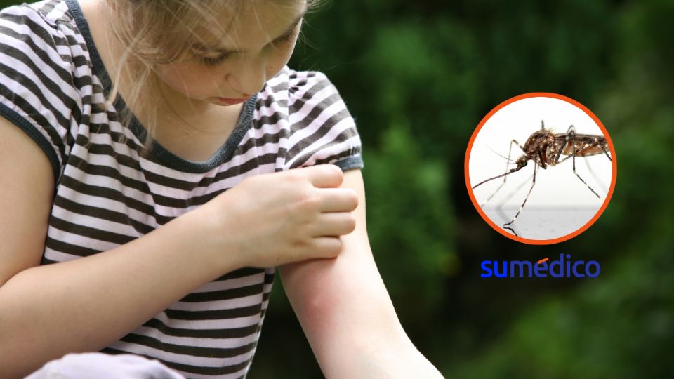 Así puedes alikviar las picaduras de mosquitos este verano