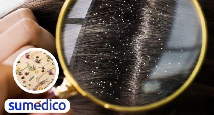 Elimina la caspa con estos 5 remedios naturales