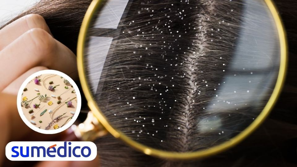 Despídete de la caspa en el cuero cabelludo y en el cabello con estos remedios naturales.