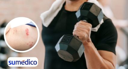 ¿Infecciones en la piel por el gimnasio? Conoce cuáles son y cómo prevenirlas