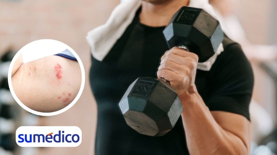 ¿Acudes al gimnasio? Conoce cómo prevenir infecciones en la piel.