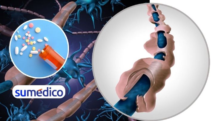 OMS integra fármacos contra esclerosis múltiple en su lista de medicamentos esenciales