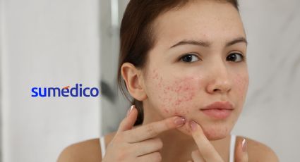 La Fundación Mexicana para la Dermatología anuncia jornada gratuita para atención del acné