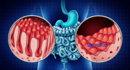 Riesgos de las enfermedades inflamatorias intestinales; un mal silencioso