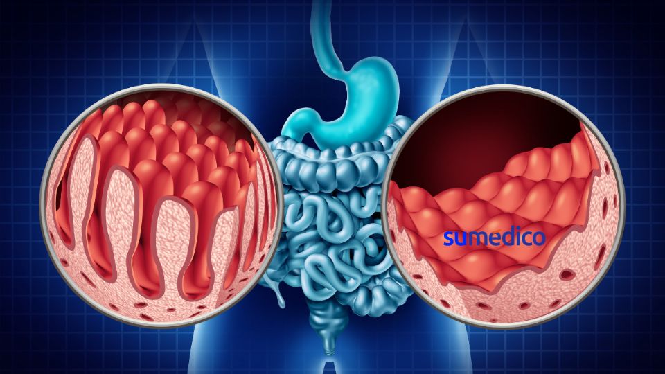 La enfermedades inflamatorias intestinales son más recurrentes en hombres