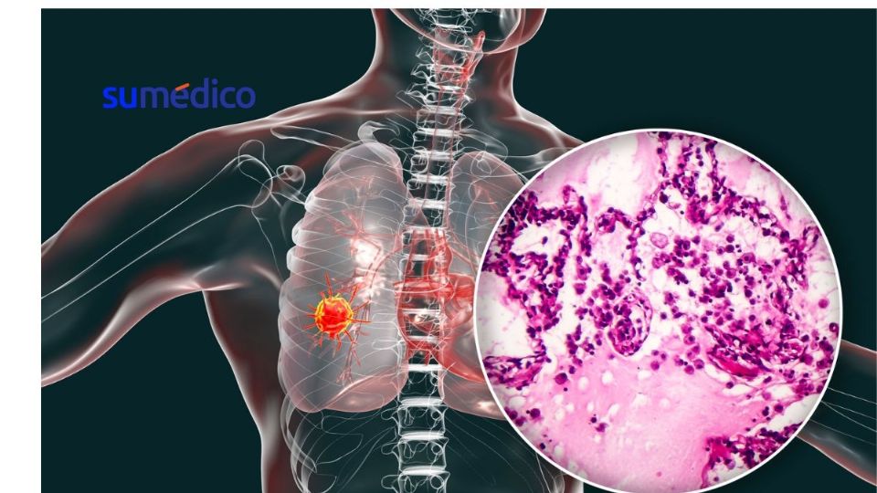 El cáncer de pulmón es un tipo de cáncer que se inicia cuando las células de los pulmones tienen un crecimiento descontrolado.