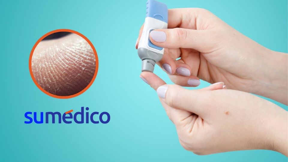 ¿Cómo afecta la diabetes a la piel? Esto conocemos.