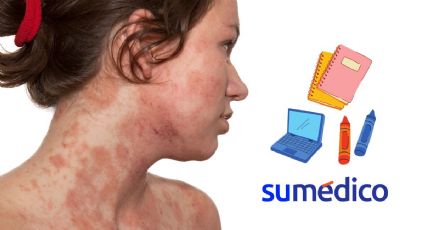 Regreso a clases con dermatitis atópica, consejos para cuidar la piel de los niños