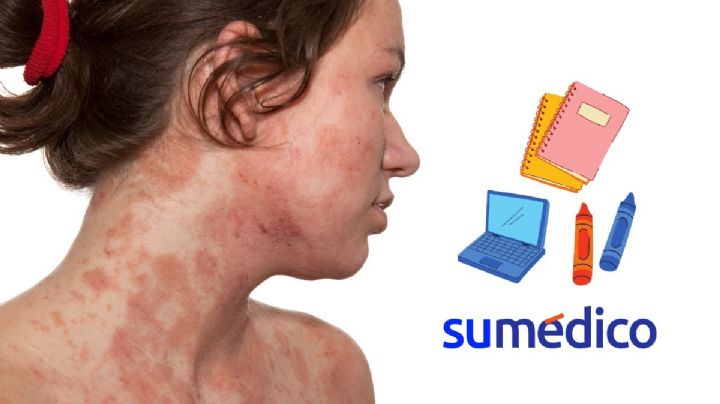 Regreso a clases con dermatitis atópica, consejos para cuidar la piel de los niños