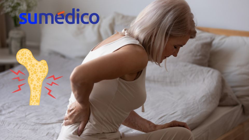 La osteoporosis puede causar fracturas con facilidad.