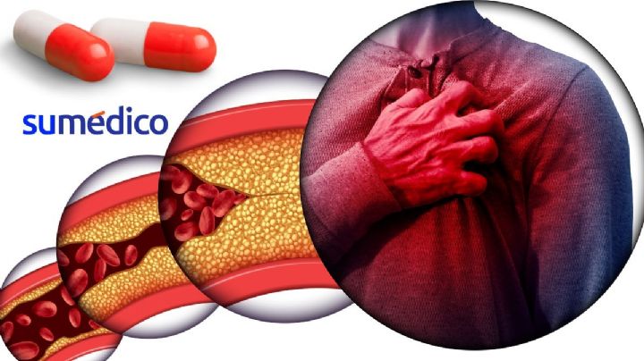 OMS integra polipíldora contra enfermedades cardiovasculares en su lista de medicamentos esenciales