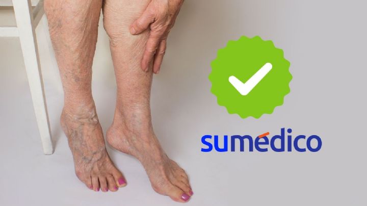 Estos 5 hábitos te ayudarán a disminuir las várices