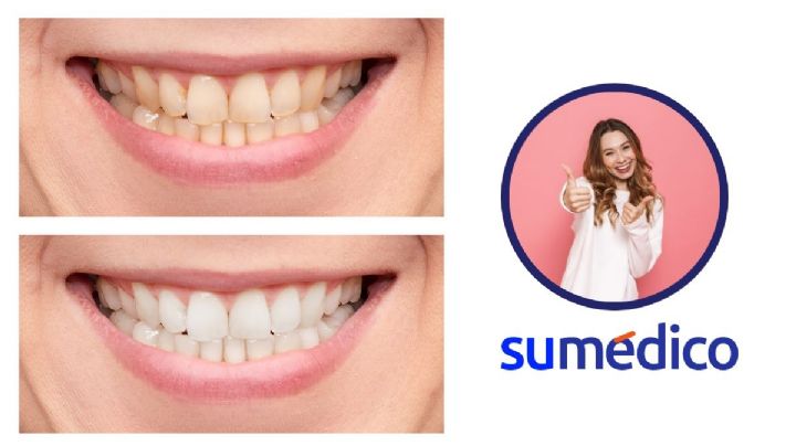 ¿Cómo blanquear los dientes de forma natural? 5 maneras sencillas