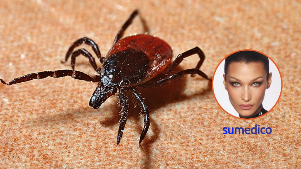 La enfermedad de Lyme se contrae a través de garrapatas infectadas con la bacteria