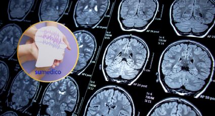 Estudio avanza en análisis de la epilepsia y qué factores la originan genéticamente