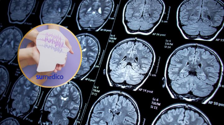 Estudio avanza en análisis de la epilepsia y qué factores la originan genéticamente