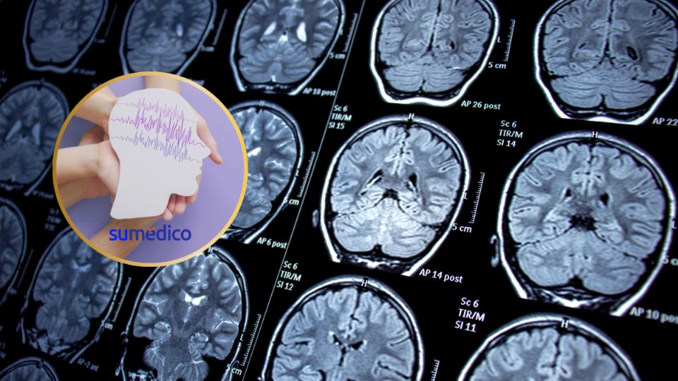 Un nuevo estudio revela nuevos datos sobre la epilepsia 
