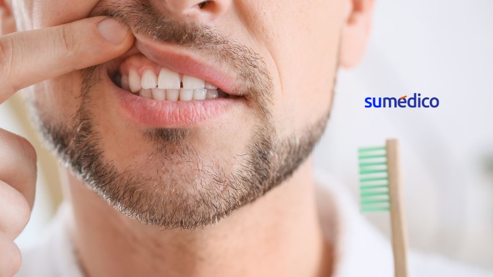 La gingivitis puede prevenirse con una buena higiene bucal