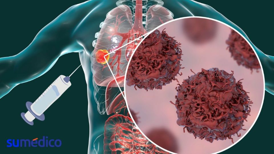 Las vacunas contra el cáncer de pulmón podrían ser de gran ayuda.