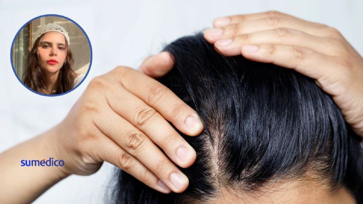 ¿Qué causa la alopecia en mujeres como la que padece Yuya?