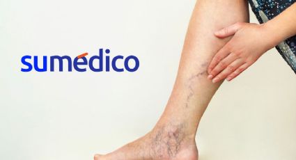 ¿Qué fruta puede ayudar a controlar las varices?