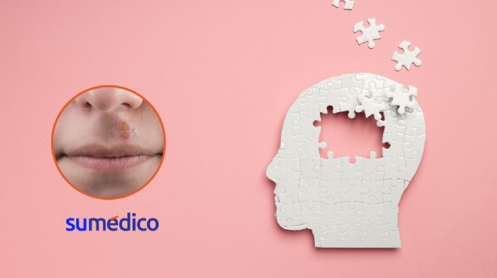 Estudian la posible incidencia del virus del herpes simple 1 en el Alzheimer