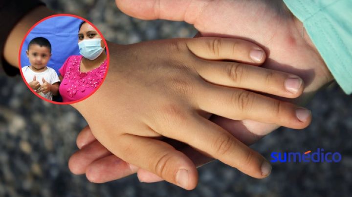 Salvan de amputación a niño con macrodactilia ¿Qué es este padecimiento?