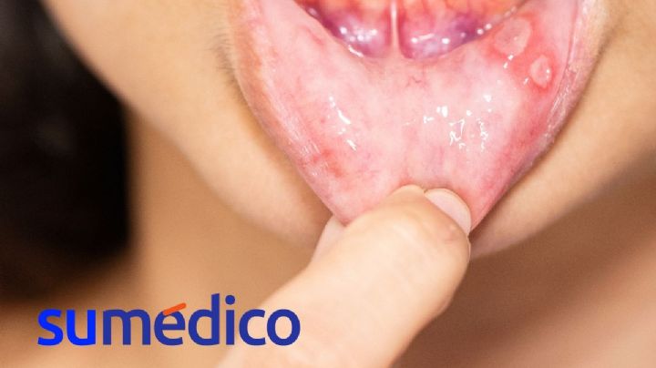 Fuegos en la boca, una señal de la falta de esta vitamina