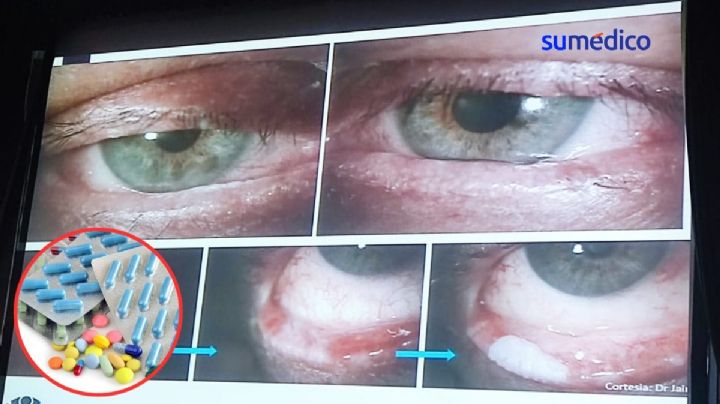 5 medicamentos anticancerígenos que afectan la salud ocular