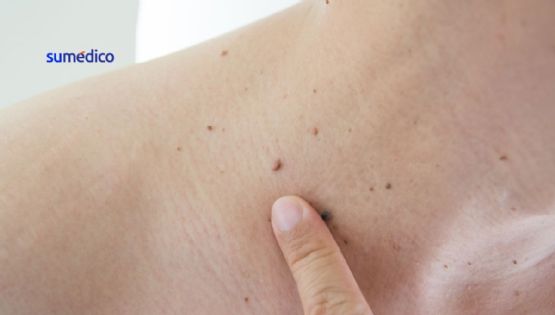 ¿Existen remedios efectivos contra las verrugas?