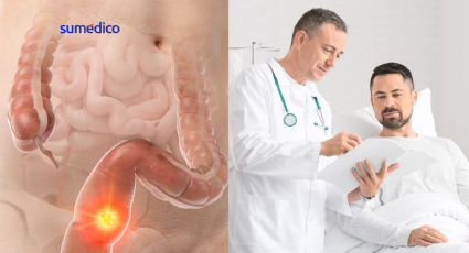 ¿Por qué deberías conocer los síntomas de cáncer de colon si eres millennial?