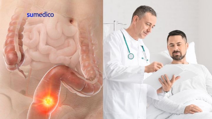 ¿Por qué deberías conocer los síntomas de cáncer de colon si eres millennial?