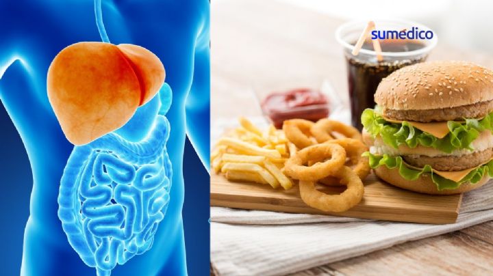 5 alimentos que empeoran el hígado graso