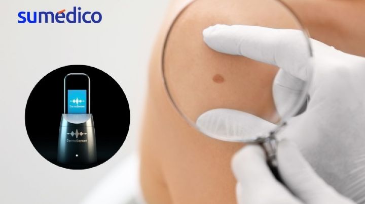 ¿Cómo es el dispositivo de IA que la FDA aprobó para detectar el cáncer de piel?