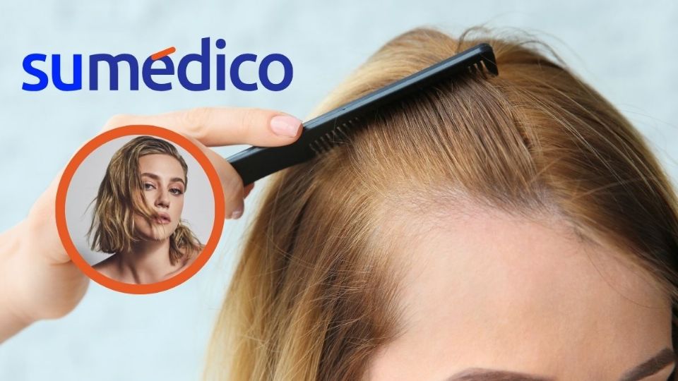 Lili Reinhart comparte sobre su diagnóstico de alopecia, probablemente relacionada con un efecto secundario de una depresión.